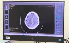 Возраст или образ жизни: инсульт стремительно молодеет