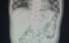 Иглу нашли в брюшной полости младенца в Туркестане