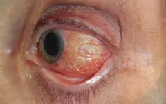 Живого червя достали из глаза мужчины после укуса комара