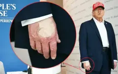 Разгадана тайна синяков Трампа